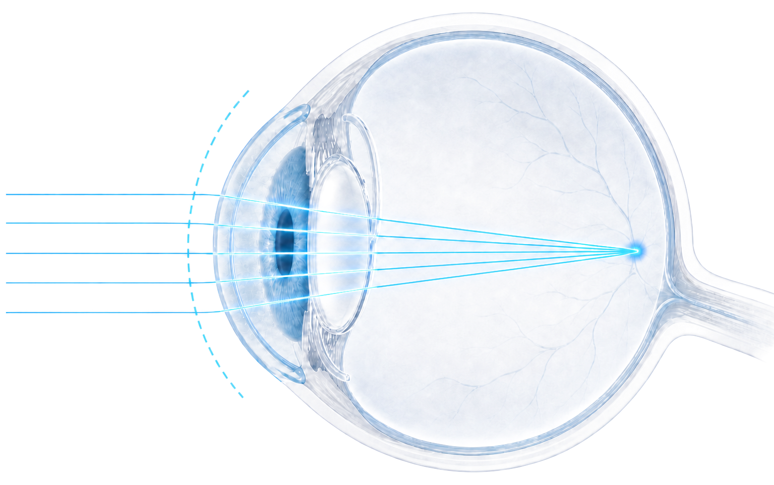 Postoperative residual refractive astigmatism eye diagram showing light focused on the retina